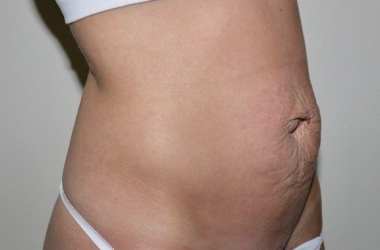 Before Image: Abdominoplasty - right-front-oblique