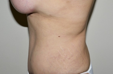 After Image: Abdominoplasty - left-side