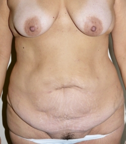Before Image: Abdominoplasty - front