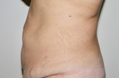 Before Image: Abdominoplasty - left-side