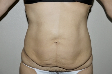 Before Image: Abdominoplasty - front