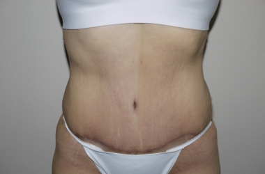 After Image: Abdominoplasty - front