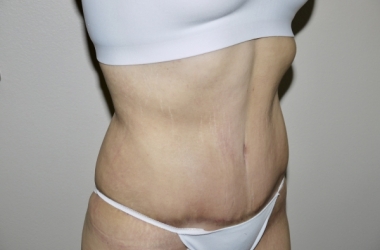 After Image: Abdominoplasty - right-front-oblique