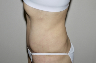 After Image: Abdominoplasty - left-side