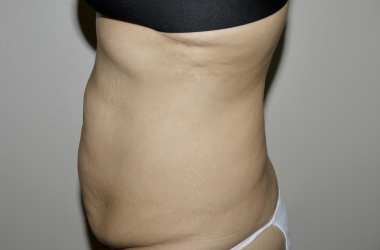 Before Image: Abdominoplasty - left-side