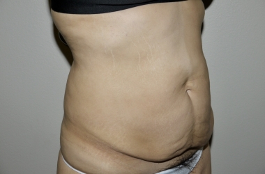 Before Image: Abdominoplasty - right-front-oblique