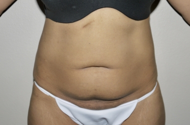 Before Image: Abdominoplasty - front