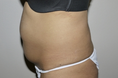 Before Image: Abdominoplasty - left-side