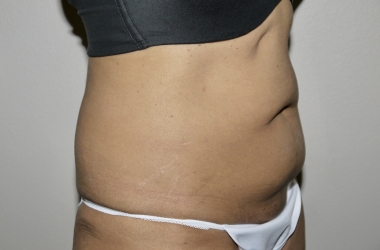 Before Image: Abdominoplasty - right-front-oblique
