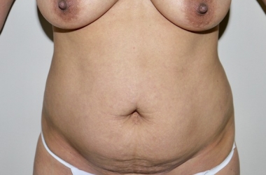Before Image: Abdominoplasty - front