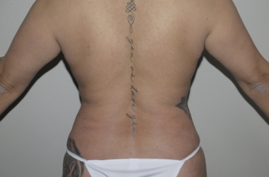 After Image: Abdominoplasty - back