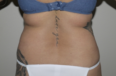 Before Image: Abdominoplasty - back