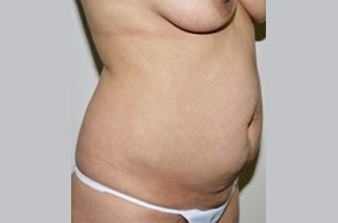 Before Image: Abdominoplasty - front