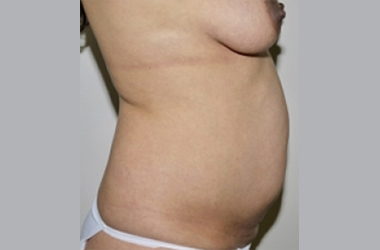 Before Image: Abdominoplasty - right-side