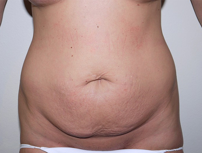 Before Image: Abdominoplasty - front