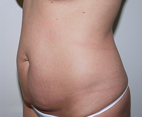 Before Image: Abdominoplasty - left-front-oblique
