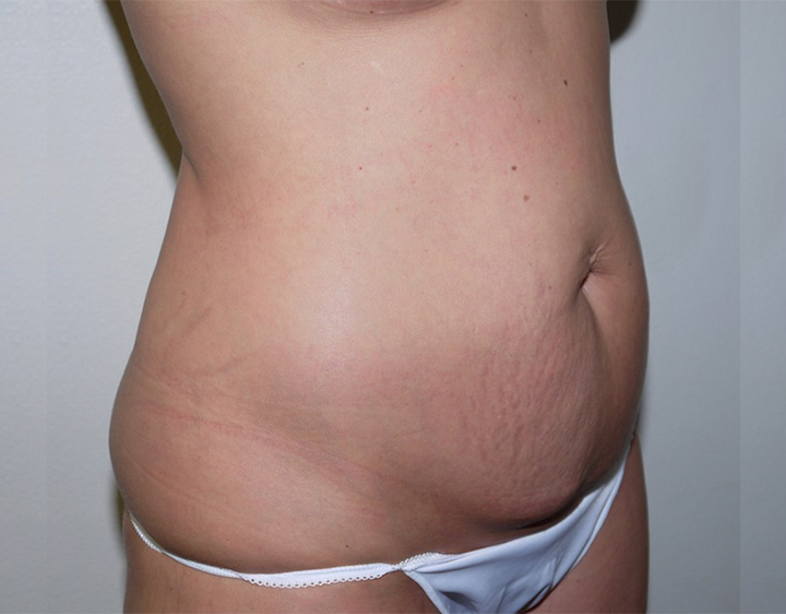 Before Image: Abdominoplasty - right-front-oblique