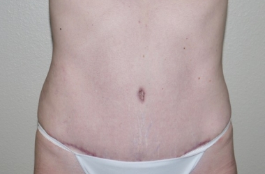 After Image: Abdominoplasty - front