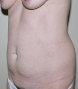 Before Image: Abdominoplasty - left-front-oblique