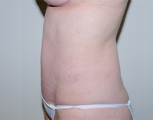 After Image: Abdominoplasty - left-side