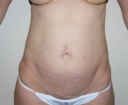 Before Image: Abdominoplasty - front