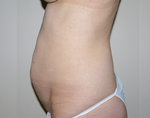Before Image: Abdominoplasty - left-side