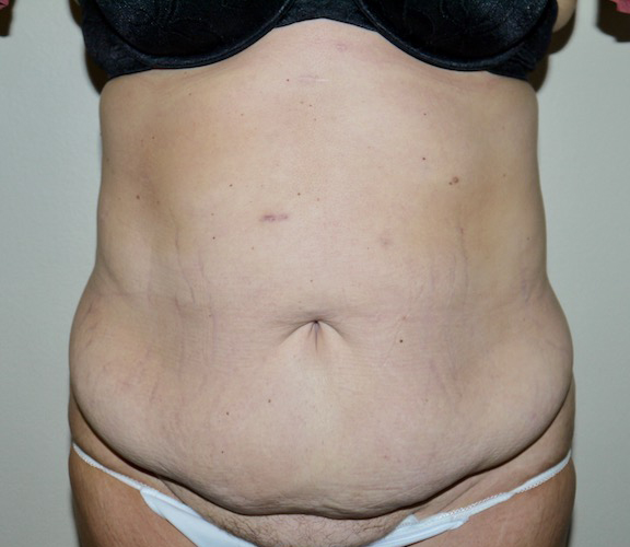 Before Image: Abdominoplasty - front