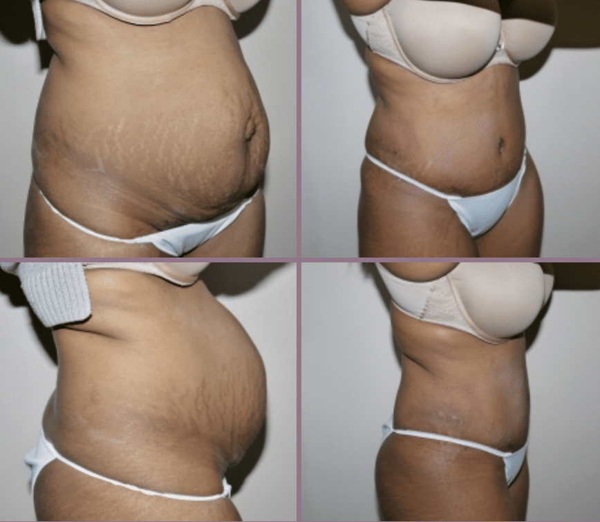 will i go down a pant size after tummy tuck 6414a039816c1