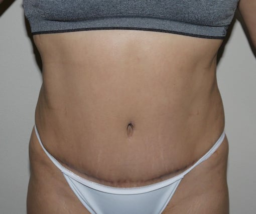 After Image: Abdominoplasty - front