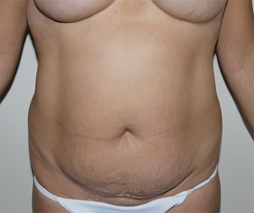 Before Image: Abdominoplasty - front