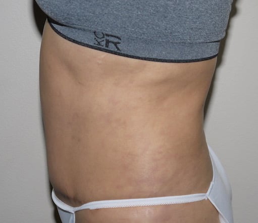 After Image: Abdominoplasty - left-side