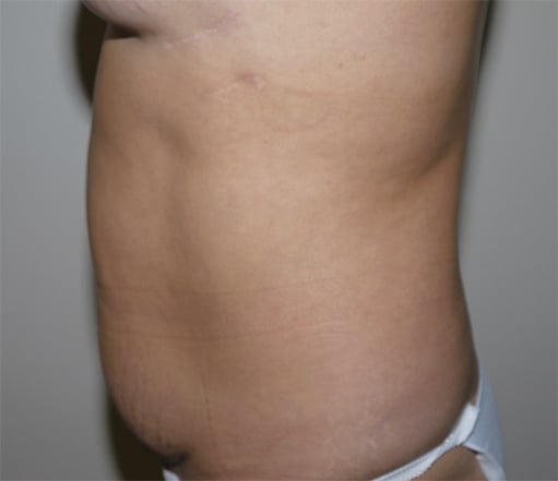 Before Image: Abdominoplasty - left-side