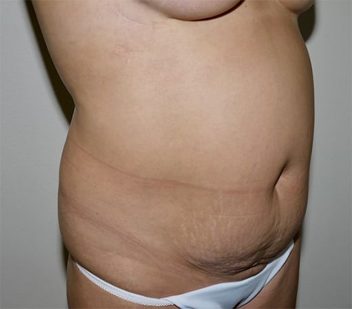 Before Image: Abdominoplasty - right-front-oblique