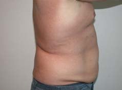 Before Image: Liposuction - right-side