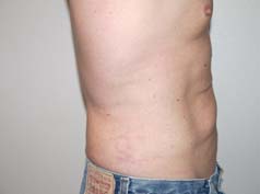 After Image: Liposuction - right-side