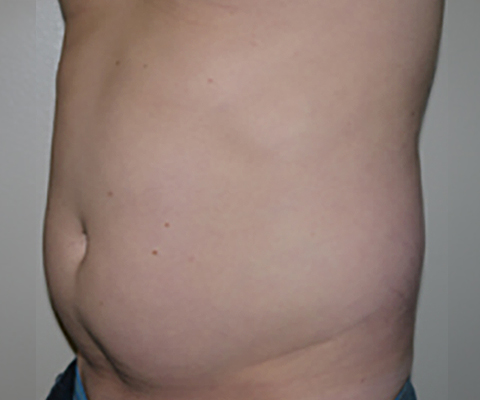 Before Image: Liposuction - left-front-oblique