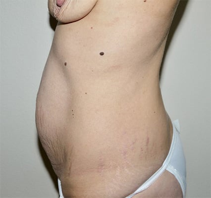 Before Image: Abdominoplasty - left-side
