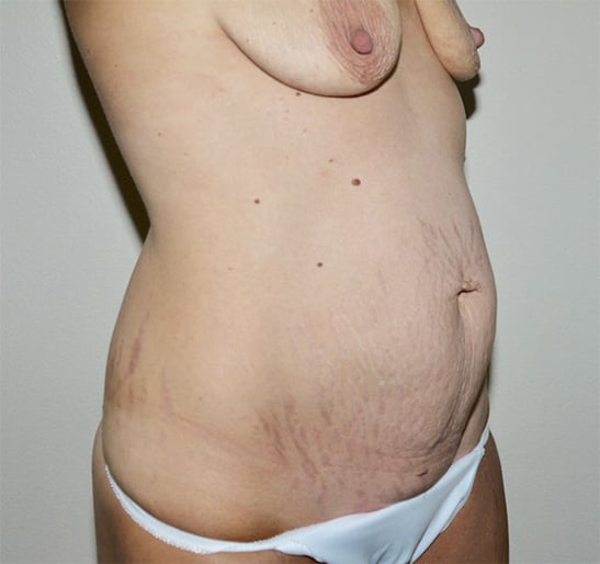 Before Image: Abdominoplasty - right-front-oblique