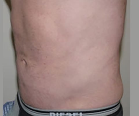 After Image: Liposuction - left-front-oblique