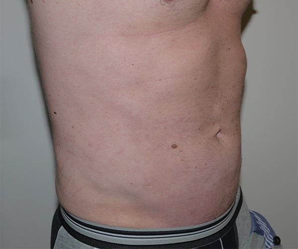 After Image: Liposuction - right-front-oblique