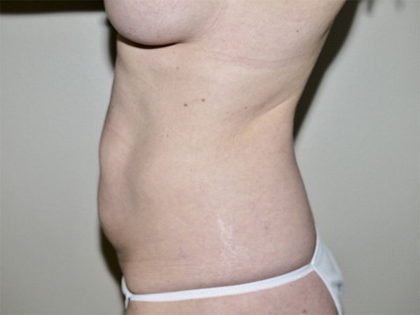 Before Image: Abdominoplasty - left-side