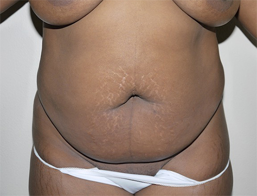 Before Image: Abdominoplasty - front