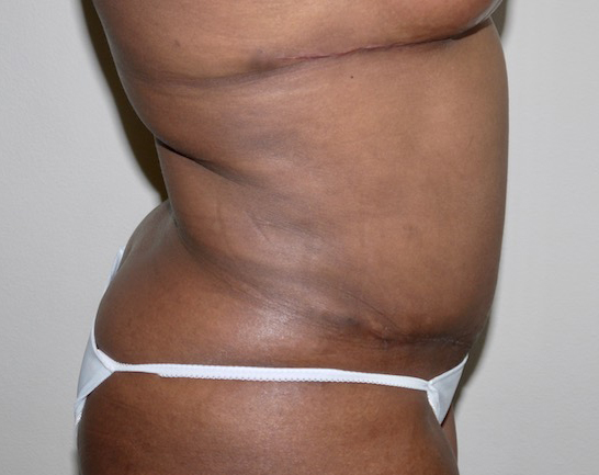 After Image: Abdominoplasty - right-side