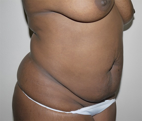 Before Image: Abdominoplasty - right-front-oblique