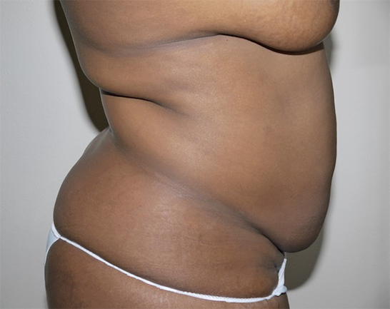 Before Image: Abdominoplasty - right-side