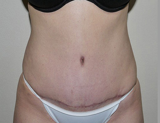 After Image: Abdominoplasty - front