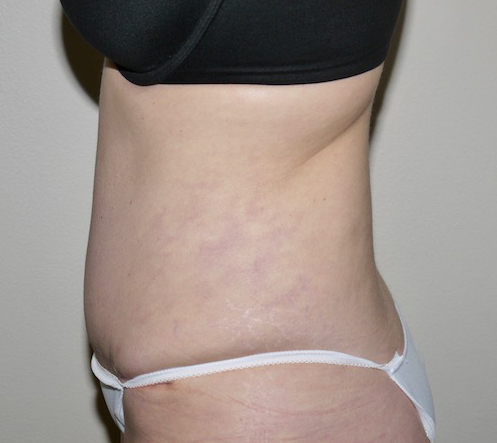 After Image: Abdominoplasty - left-side