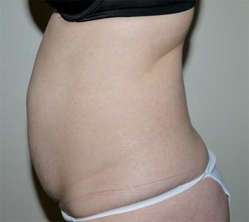 Before Image: Abdominoplasty - left-side