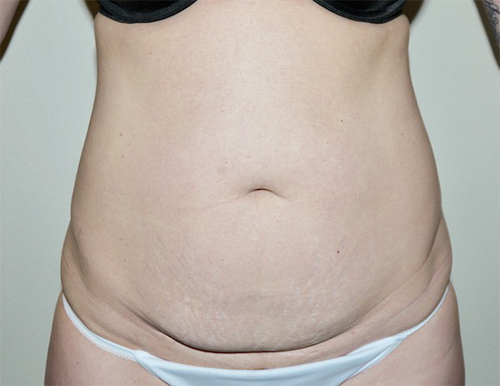 Before Image: Abdominoplasty - front