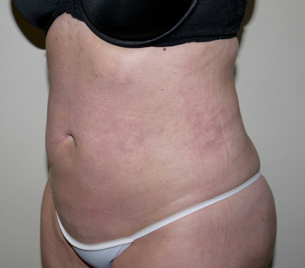 After Image: Liposuction - left-front-oblique